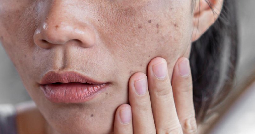 Laser Treatment for pigmentation